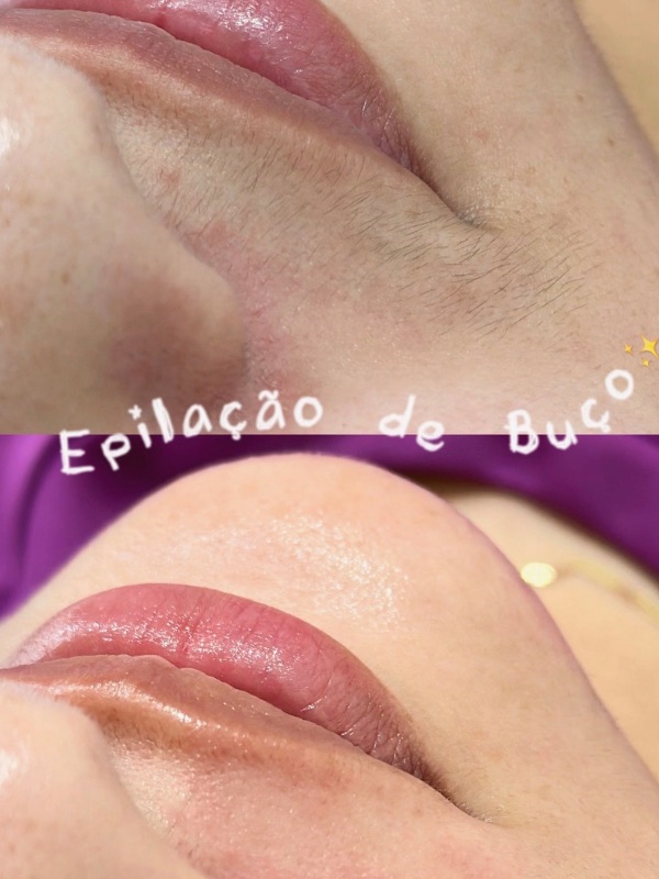 Depilação Rosto